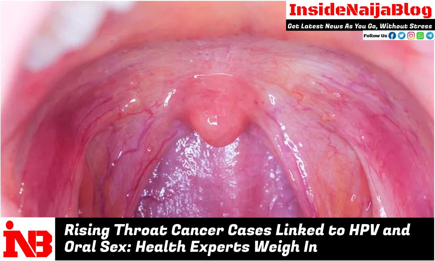 Rising Throat Cancer Cases Linked to HPV and Oral Sex: Health Experts Weigh In